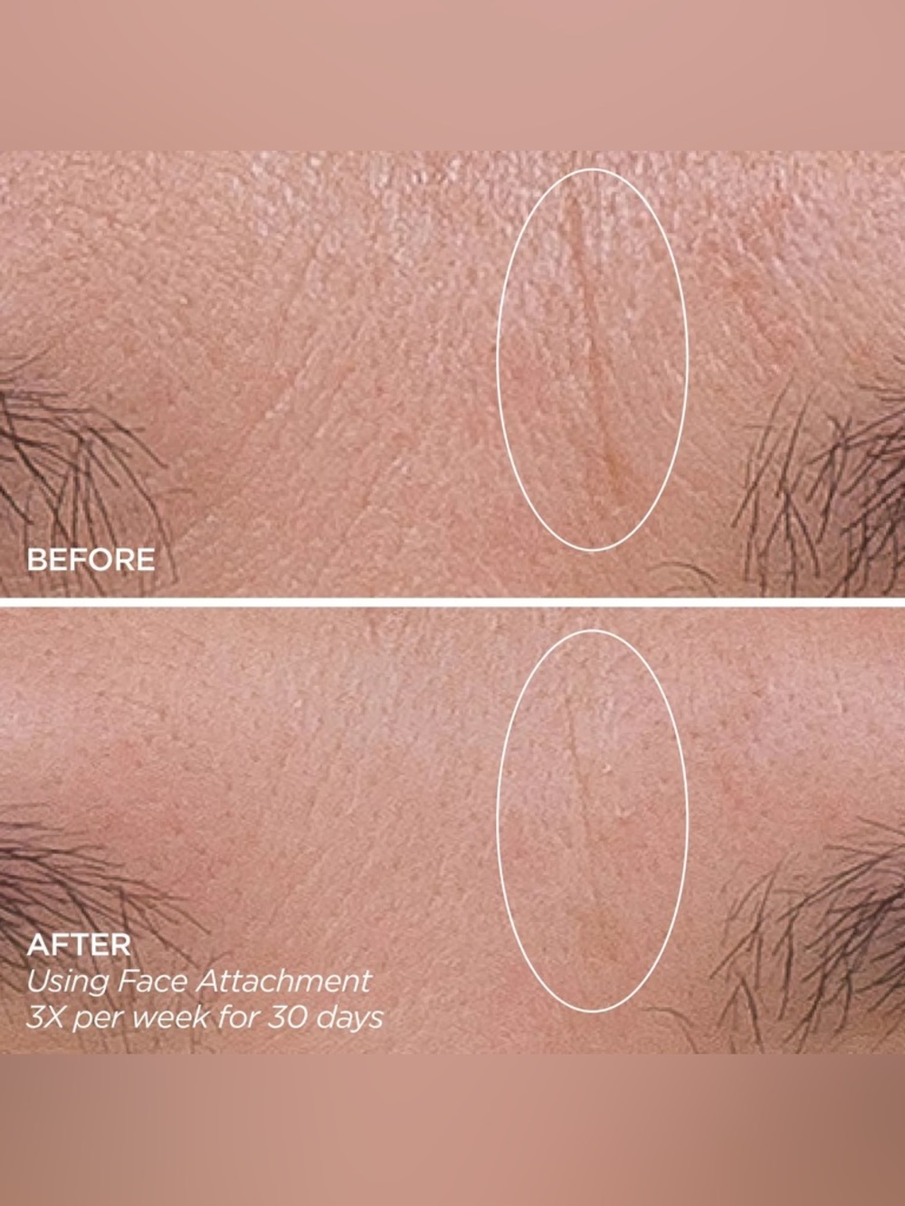 BNIP- GloPRO Microneedling Tool and Tru Face Line Corrector Kit - Picture 8 of 16